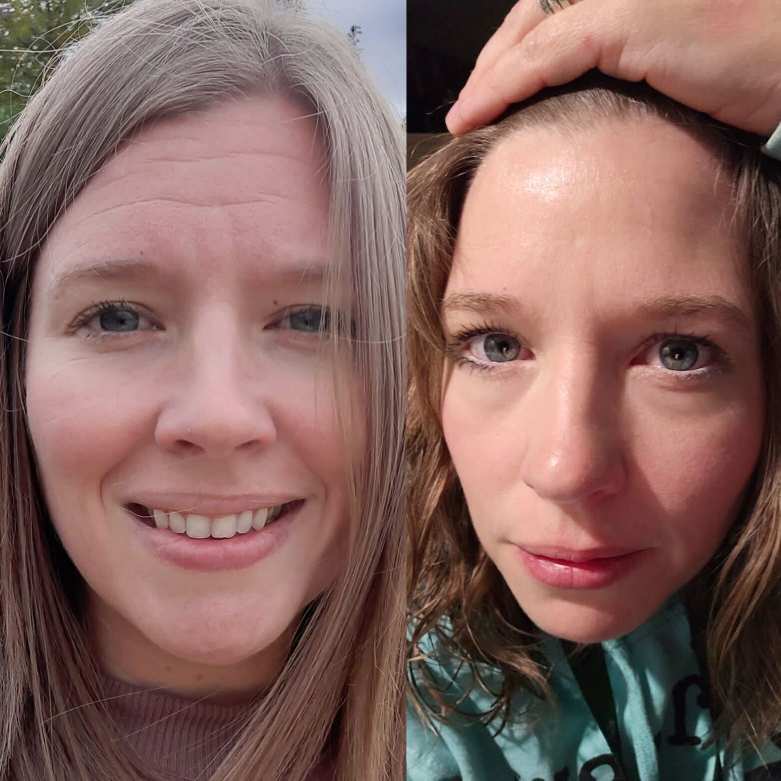 Before image with horizontal lines on the forehead after frownies image with a smooth forehead