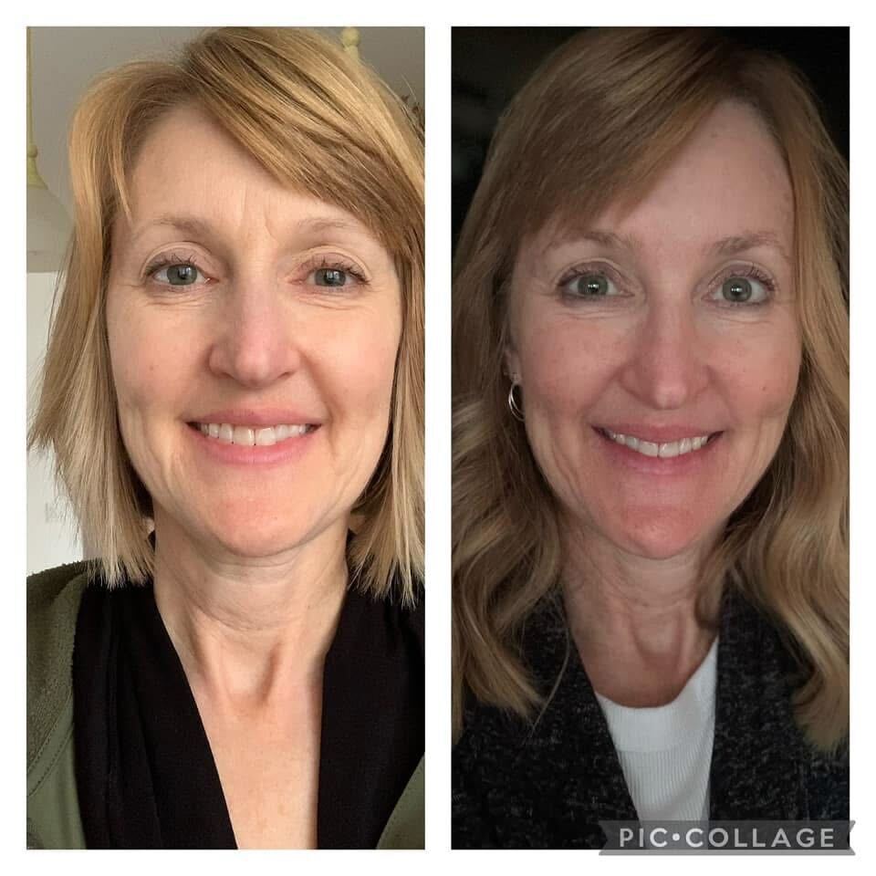 Before image with vertical lines on the forehead after frownies image with a smooth forehead