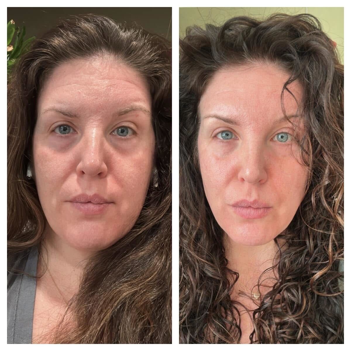 Before image with horizontal lines on the forehead after frownies image with a smooth forehead 